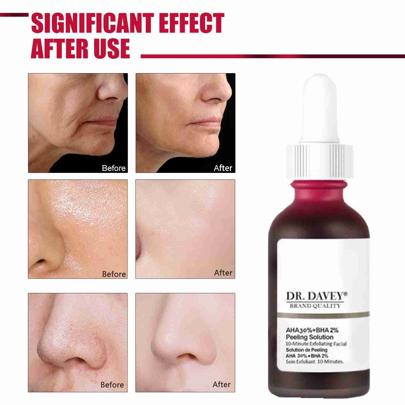AHA 30% + BHA 2% Peeling Solution