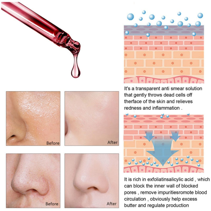 AHA 30% + BHA 2% Peeling Solution