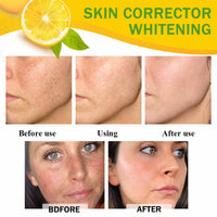 Dark Spot Corrector Cream, Skin Bleaching Cream, Various Spots Removal, Whitening Face Cream, With Organic Papaya, Anti-freckles