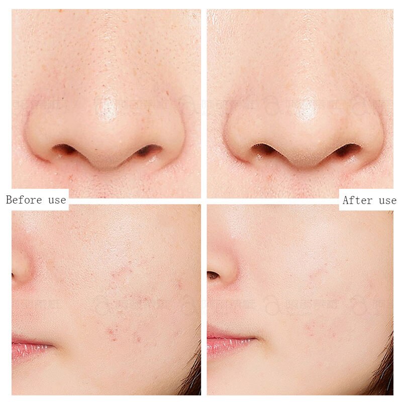 Salicylic Acid 2 Mask Clean And Mild No Stimulation Improve Roughness And Shrink Pores Exfoliated Closed Mouth Acne 50ml
